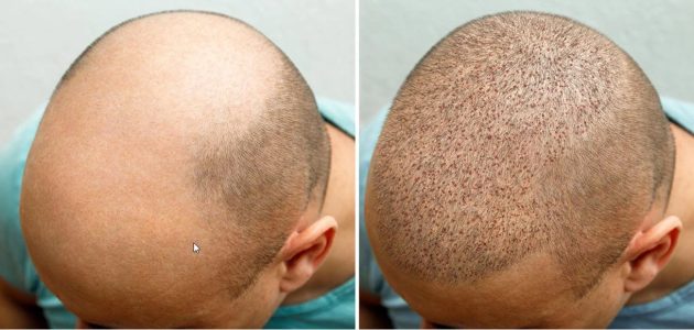 كم تكلفة زراعة الشعر في تركيا بالدولار تكلفة زراعة الشعر في تركيا